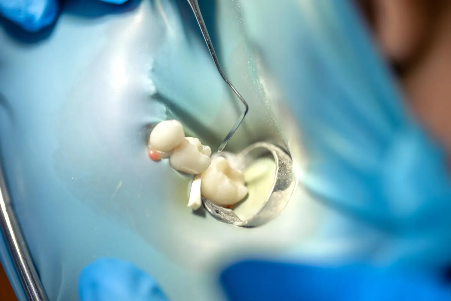 Bagaimana Cara Menghilangkan Amalgam yang Sudah Terpasang?